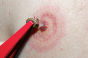 Skin with red splotch, tick being pulled out